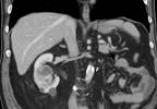 RCC or Dialysis: Risk Stratification and Assessment RCC or Dialysis: Risk Stratification and Assessment