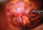 Robotic NSS Without Ischemia for Exophytic Small Renal Masses Robotic NSS Without Ischemia for Exophytic Small Renal Masses