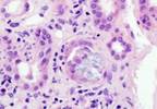 TURP Better than PAE for Bladder Outlet Obstruction TURP Better than PAE for Bladder Outlet Obstruction