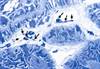 Fabry Disease: The Nephrologist's Role Fabry Disease: The Nephrologist's Role