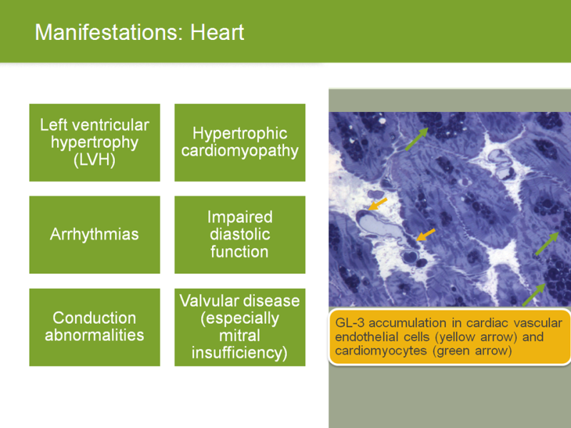 Fabry Disease The Nephrologist S Role Presentation By David G Warnock Md