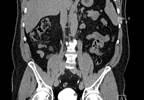 Study Identifies RCC Predictors Study Identifies RCC Predictors