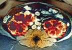 Renal Replacement Therapy Trends in ADPKD Characterized Renal Replacement Therapy Trends in ADPKD Characterized