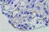 TSC-Related Pediatric Renal Tumors Respond to Everolimus TSC-Related Pediatric Renal Tumors Respond to Everolimus