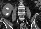 Moderate-to-Severe Lower Urinary Tract Symptoms (LUTS) Undertreated Moderate-to-Severe Lower Urinary Tract Symptoms (LUTS) Undertreated