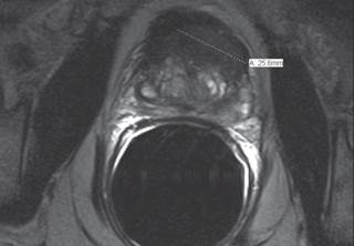 MRI can pinpoint a prostate tumor for targeted treatment. MRI can pinpoint a prostate tumor for targeted treatment.