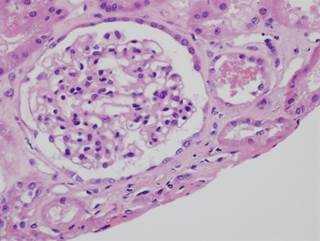 Technique provides a tissue diagnosis in 88% of cases, according to a study. Technique provides a tissue diagnosis in 88% of cases, according to a study.