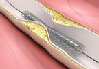 Stent Lawsuit Settles on the Eve of a Doctor's Testimony Stent Lawsuit Settles on the Eve of a Doctor's Testimony