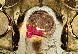 Metformin's efficacy in treating prostate cancer is questionable. Metformin's efficacy in treating prostate cancer is questionable.
