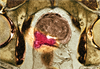 Diabetes Drug's Prostate Cancer Benefit Unclear Diabetes Drug's Prostate Cancer Benefit Unclear