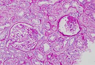 Platelets may aggregate more easily in iron-deficient patients. Platelets may aggregate more easily in iron-deficient patients.
