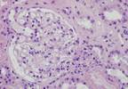 High Uric Acid May Hasten Dialysis Initiation High Uric Acid May Hasten Dialysis Initiation