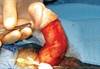 FDA Approves Peyronie's Disease Drug FDA Approves Peyronie's Disease Drug