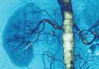 Stenting May Improve Transplant Renal Artery Stenosis Outcomes Stenting May Improve Transplant Renal Artery Stenosis Outcomes