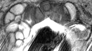 This rate of incidental PCa detection is lower than found in previous studies. This rate of incidental PCa detection is lower than found in previous studies.