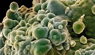 SBRT Less Costly, More Toxic Than IMRT for Prostate Cancer SBRT Less Costly, More Toxic Than IMRT for Prostate Cancer