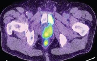 PET imaging with a PSMA-targeting agent showed an ability to detect larger and higher-grade tumors. PET imaging with a PSMA-targeting agent showed an ability to detect larger and higher-grade tumors.