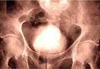 Water Ablation for BPH Lessens Risk of Ejaculatory Dysfunction Water Ablation for BPH Lessens Risk of Ejaculatory Dysfunction