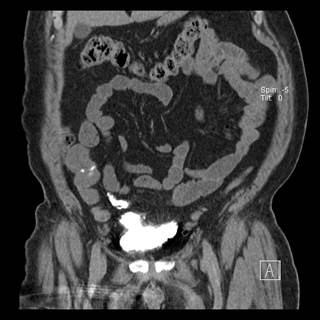 Alvimopan also was found to shorten hospital length of stay. Alvimopan also was found to shorten hospital length of stay.