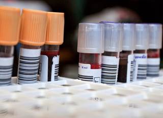 A PHI of 82 discriminated between patients with and without biochemical recurrence. A PHI of 82 discriminated between patients with and without biochemical recurrence.