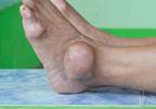 Gout Risk Linked to Body Mass Index Gout Risk Linked to Body Mass Index