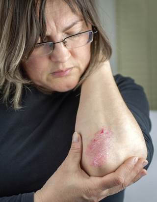 Women who had hypertension for at least 6 years had a 27% increased risk of the skin disease. Women who had hypertension for at least 6 years had a 27% increased risk of the skin disease.