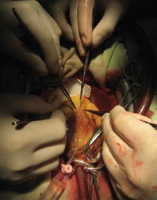 Severe CKD raised the risk of in-hospital death after coronary artery bypass grafting surgery. Severe CKD raised the risk of in-hospital death after coronary artery bypass grafting surgery.