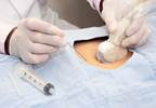 Ultrasound Overused in Boys With Undescended Testicles Ultrasound Overused in Boys With Undescended Testicles
