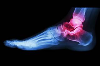 Women with this form of arthritis are more susceptible, researchers say. Women with this form of arthritis are more susceptible, researchers say.