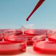 Earlier Use of ESAs Benefits Non-Dialysis Kidney Disease (CKD) Patients Earlier Use of ESAs Benefits Non-Dialysis Kidney Disease (CKD) Patients