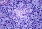 Targeted Multigene Panel Testing Useful for Hereditary Kidney Cancer Targeted Multigene Panel Testing Useful for Hereditary Kidney Cancer