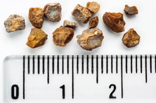 Serum uric acid levels of 10 mg/dL or higher are associated with an increased risk for nephrolithiasis. Serum uric acid levels of 10 mg/dL or higher are associated with an increased risk for nephrolithiasis.