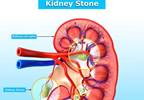 Upping Shock Wave Frequency Improves Ureteral Stone Clearance Upping Shock Wave Frequency Improves Ureteral Stone Clearance