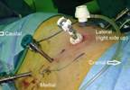 Robotic Partial Nephrectomy Mostly Superior to Other Surgeries Robotic Partial Nephrectomy Mostly Superior to Other Surgeries