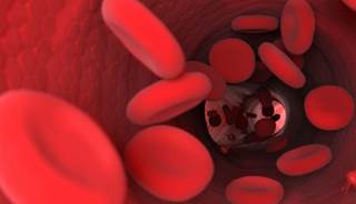Study of 109,501 incidental HD patients reveals an association between high mean corpuscular volume and increased risk of all-cause, cardiovascular, and infection-related mortality. Study of 109,501 incidental HD patients reveals an association between high mean corpuscular volume and increased risk of all-cause, cardiovascular, and infection-related mortality.