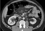 Risk Factors for Contrast-Induced AKI in Transplant Patients ID'd Risk Factors for Contrast-Induced AKI in Transplant Patients ID'd