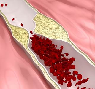 An enzyme that inhibits vascular calcification depends on the vitamin for conversion to its active form. An enzyme that inhibits vascular calcification depends on the vitamin for conversion to its active form.