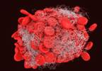 VTE Linked to Higher Death, Graft Loss Risk in Transplant Recipients VTE Linked to Higher Death, Graft Loss Risk in Transplant Recipients