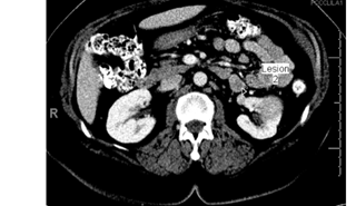 In a single-center study, 24% of patients crossed over to treatment and 95% of patients were alive after 5 years of follow-up. In a single-center study, 24% of patients crossed over to treatment and 95% of patients were alive after 5 years of follow-up.