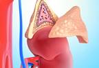 Erectile Dysfunction Risk Linked to Aldosterone Erectile Dysfunction Risk Linked to Aldosterone