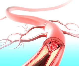 TMAO, a pro-atherogenic metabolite formed by gut microbes, predicts long-term adverse event risk and possible mortality in patients with PAD. TMAO, a pro-atherogenic metabolite formed by gut microbes, predicts long-term adverse event risk and possible mortality in patients with PAD.