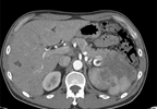 RCC Patients May Benefit from Nivolumab After Disease Progression RCC Patients May Benefit from Nivolumab After Disease Progression