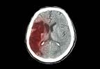 High Uric Acid Increases Risk of Non-Fatal Stroke in CKD Patients High Uric Acid Increases Risk of Non-Fatal Stroke in CKD Patients