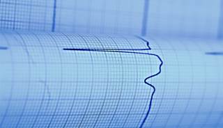 More than half of high-risk atrial fibrillation patients are not prescribed oral anticoagulants. More than half of high-risk atrial fibrillation patients are not prescribed oral anticoagulants.