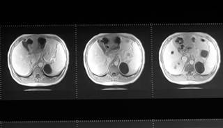 ADPKD is the most common hereditary kidney disease. ADPKD is the most common hereditary kidney disease.