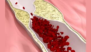 The risk of peripheral arterial disease was 34% lower for end-stage renal disease patients who underwent the procedure. The risk of peripheral arterial disease was 34% lower for end-stage renal disease patients who underwent the procedure.