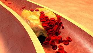 Cardiovascular disease risk is elevated when low HDL-C was accompanied by LDL-C and triglycerides. Cardiovascular disease risk is elevated when low HDL-C was accompanied by LDL-C and triglycerides.
