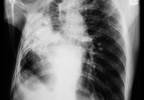 Higher FGF23 Levels Increase Odds of Respiratory Infection Higher FGF23 Levels Increase Odds of Respiratory Infection