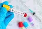 Timing of PSA Nadir Post-RP Predicts Biochemical Recurrence Risk Timing of PSA Nadir Post-RP Predicts Biochemical Recurrence Risk