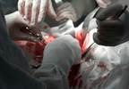 Older Age May Up Risk for RCC-Related Death After Surgery Older Age May Up Risk for RCC-Related Death After Surgery